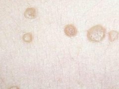 扁平疣怎样才能去掉